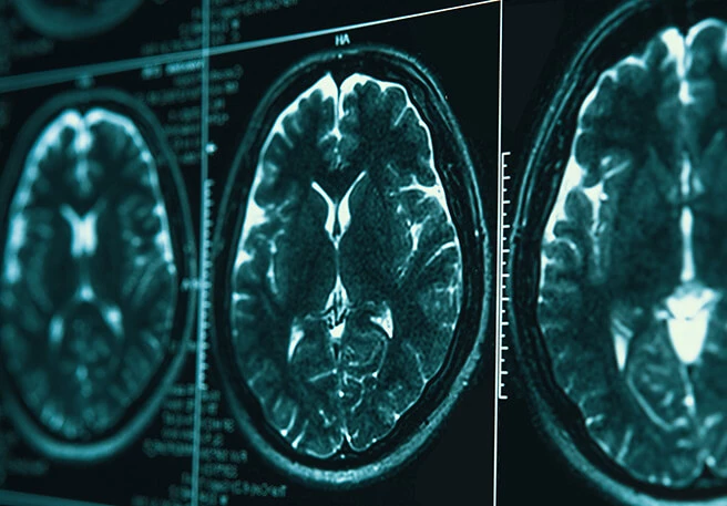 Morbus Parkinson verstehen